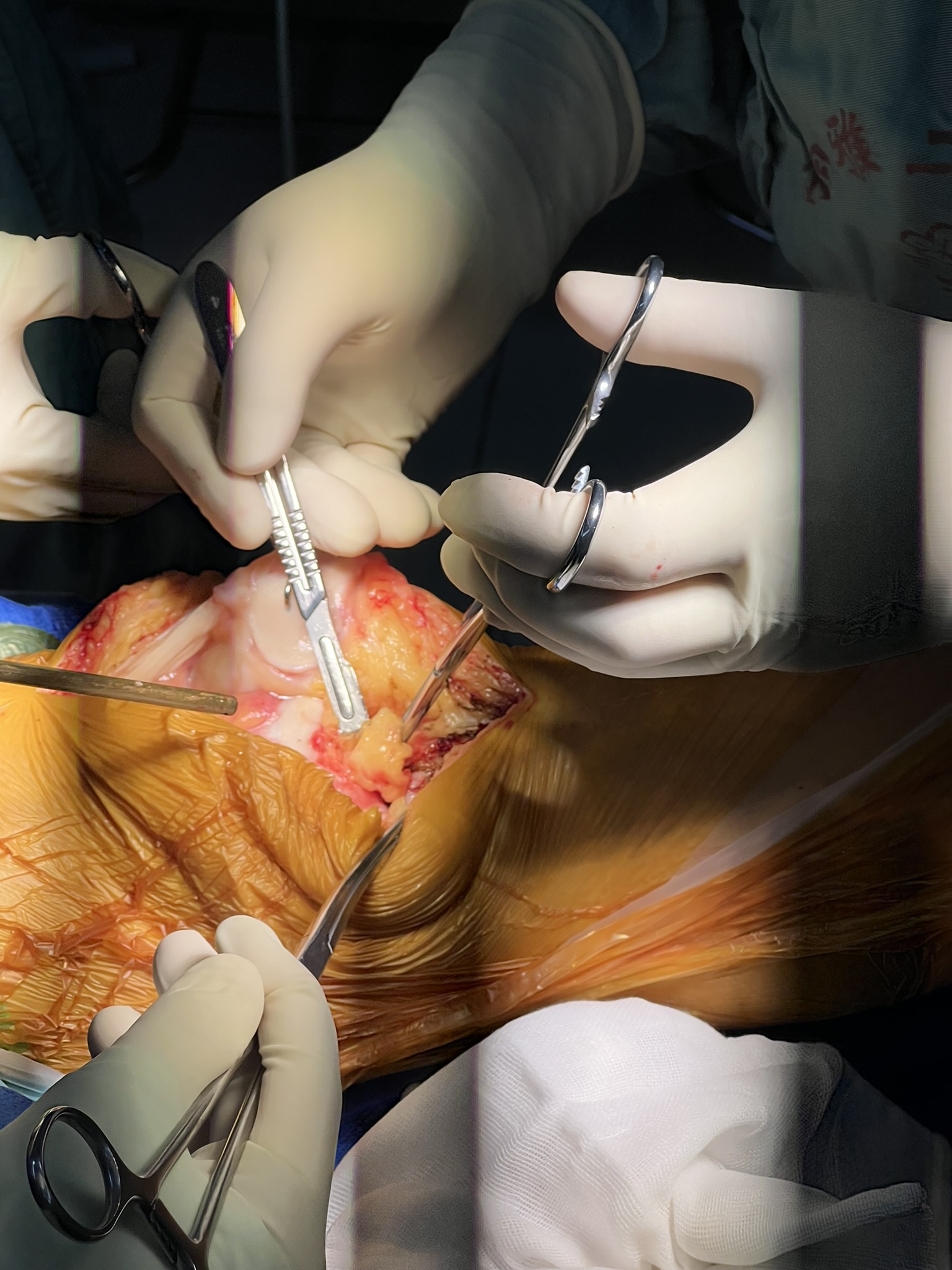 Intraoperative close-up showing gloved hands and instruments during joint surgery